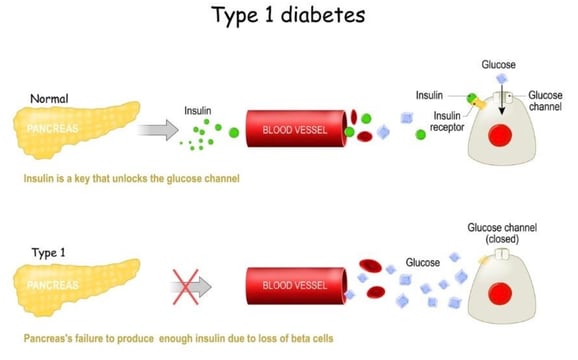 Clinical Validation – Diabetic Ketoacidosis (DKA) Blog Picture 2