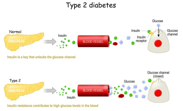 Clinical Validation – Diabetic Ketoacidosis (DKA) Blog Picture 3