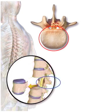 Corpectomy Picture 1