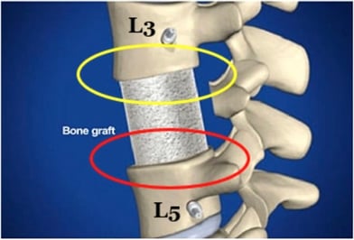 Corpectomy Picture 2