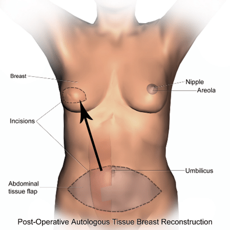 Source: https://en.wikipedia.org/wiki/Breast_reconstruction