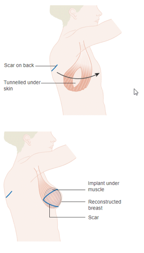 Source: https://commons.wikimedia.org/wiki/File:Diagram_showing_breast_reconstruction_using_the_latissimus_dorsi_muscle_and_an_implant_CRUK_405.svg
