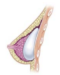 Subglandular implant (in front of pectoral muscle)