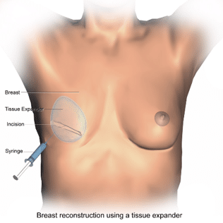 Photo courtesy Wikipedia https://en.wikipedia.org/wiki/Breast_reconstruction