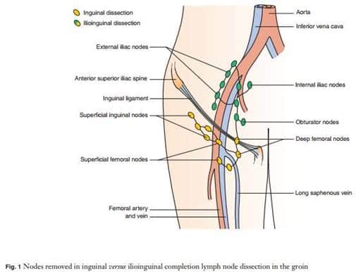 Lymphatic System – Biopsy of Lymph Node