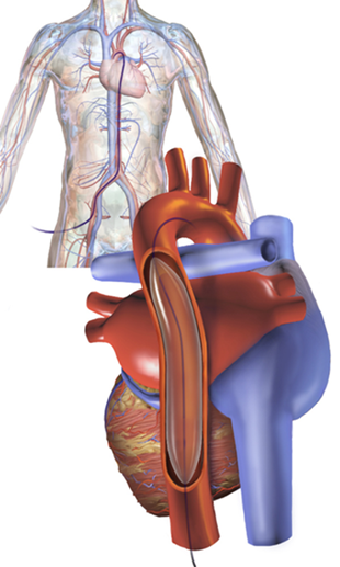 A medical illustration depicting an intra-aortic balloon pump by Bruce Blause. 8 June 2017.
