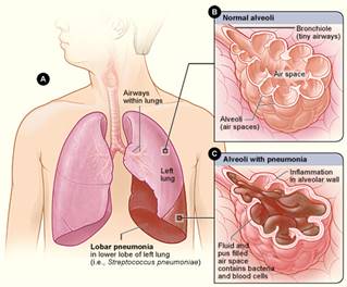 “Lobar” pneumonia references a form of pneumonia that affects a specific lobe or lobes of the lung. This is a bacterial pneumonia and is most commonly community acquired. Antibiotics are almost always necessary to clear this type of pneumonia. 