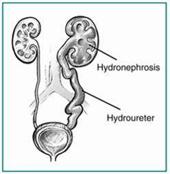 Hydronpehrosis is swelling of the kidney that develops due to improper drainage of urine from the kidney to the bladder.