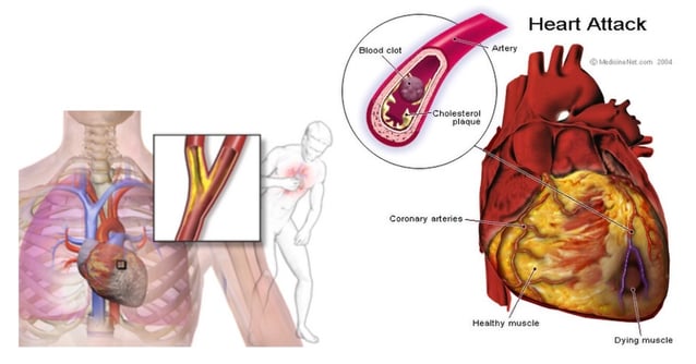Myocardial Infarction CDI Blog Picture 2