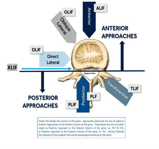 Posterior approaches