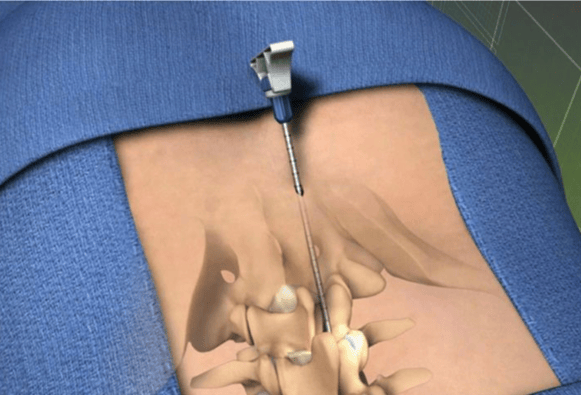 Selecting the Right CPT Code for Lumbar Spinal Decompression Surgery Picture 1