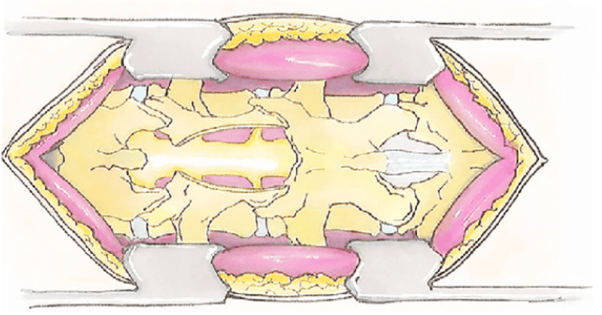 Selecting the Right CPT Code for Lumbar Spinal Decompression Surgery Picture 2