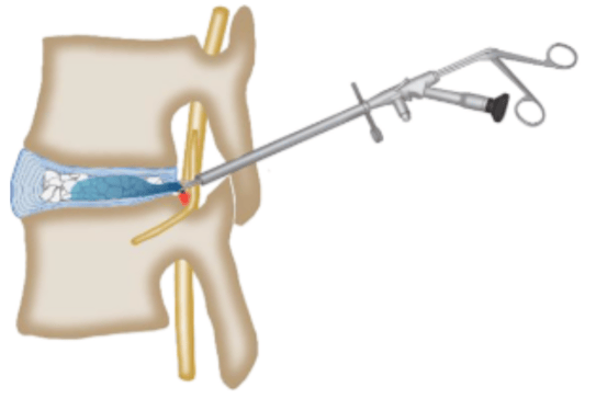 Selecting the Right CPT Code for Lumbar Spinal Decompression Surgery Picture 3