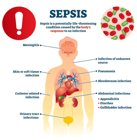 Sepsis Overview