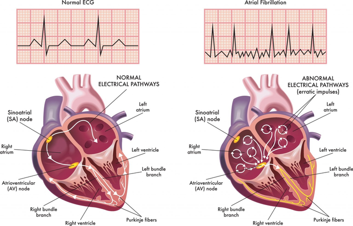 afib-heart-diagram