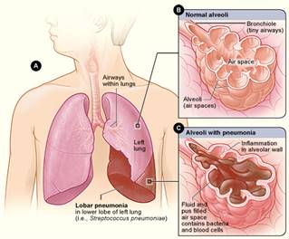 coding labor pneumonia