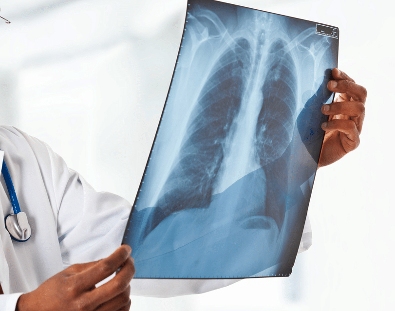 reporting "flash" pulmonary edema