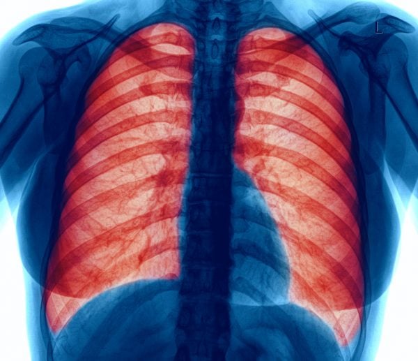 COPD Pneumonia sequencing