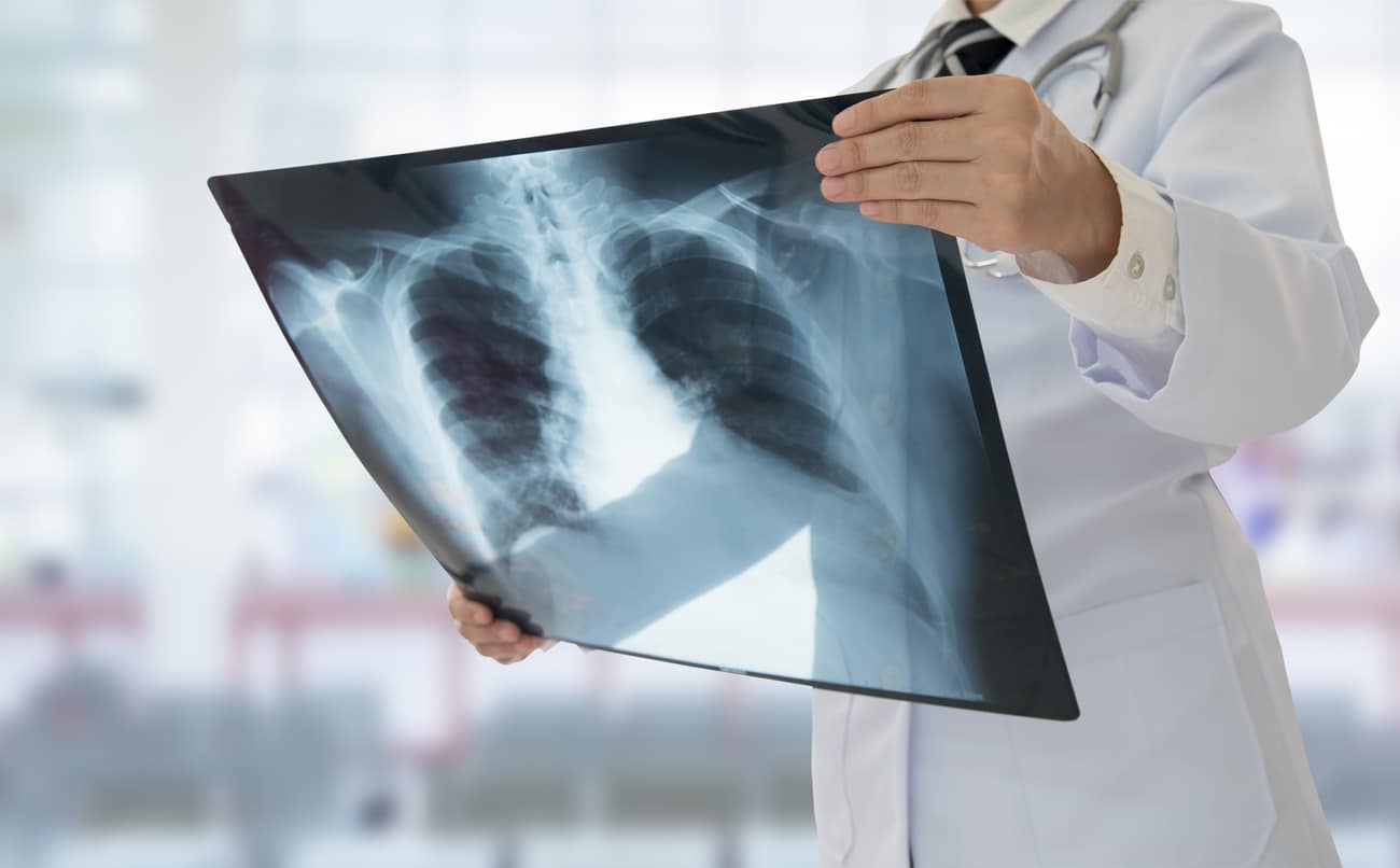 Chronic Subsegmental Pulmonary Emboli-One Code or Two?