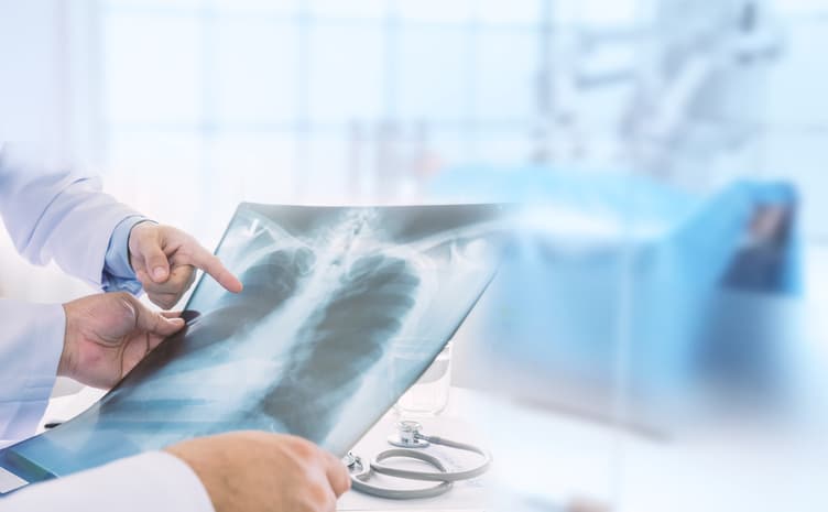 We are reviewing records where the coders are coding hydronephrosis, UTI and ureteral stona“Lobar” pneumonia references a form of pneumonia that affects a specific lobe or lobes of the lung.