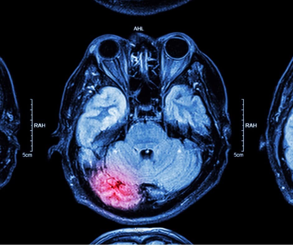 Cerebral Infarction With Hemorrhagic Conversion