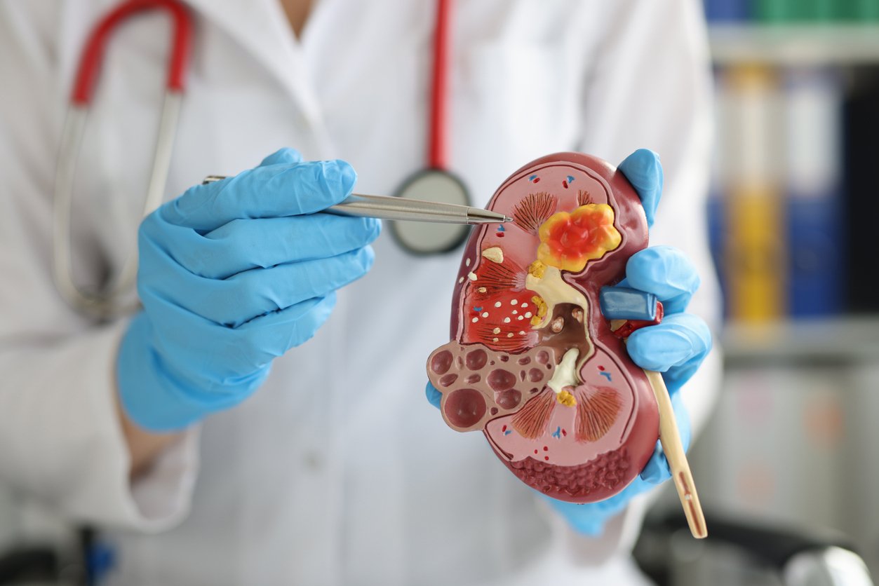 Identifying Opportunities to Query for Acute Tubular Necrosis