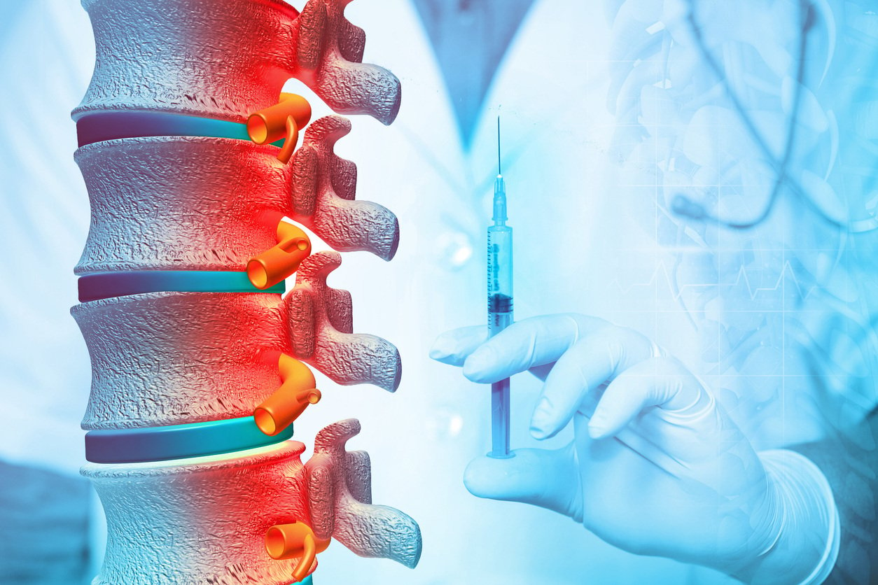 CPT Coding for Paravertebral Facet Joint Injections – the Impact of Laterality