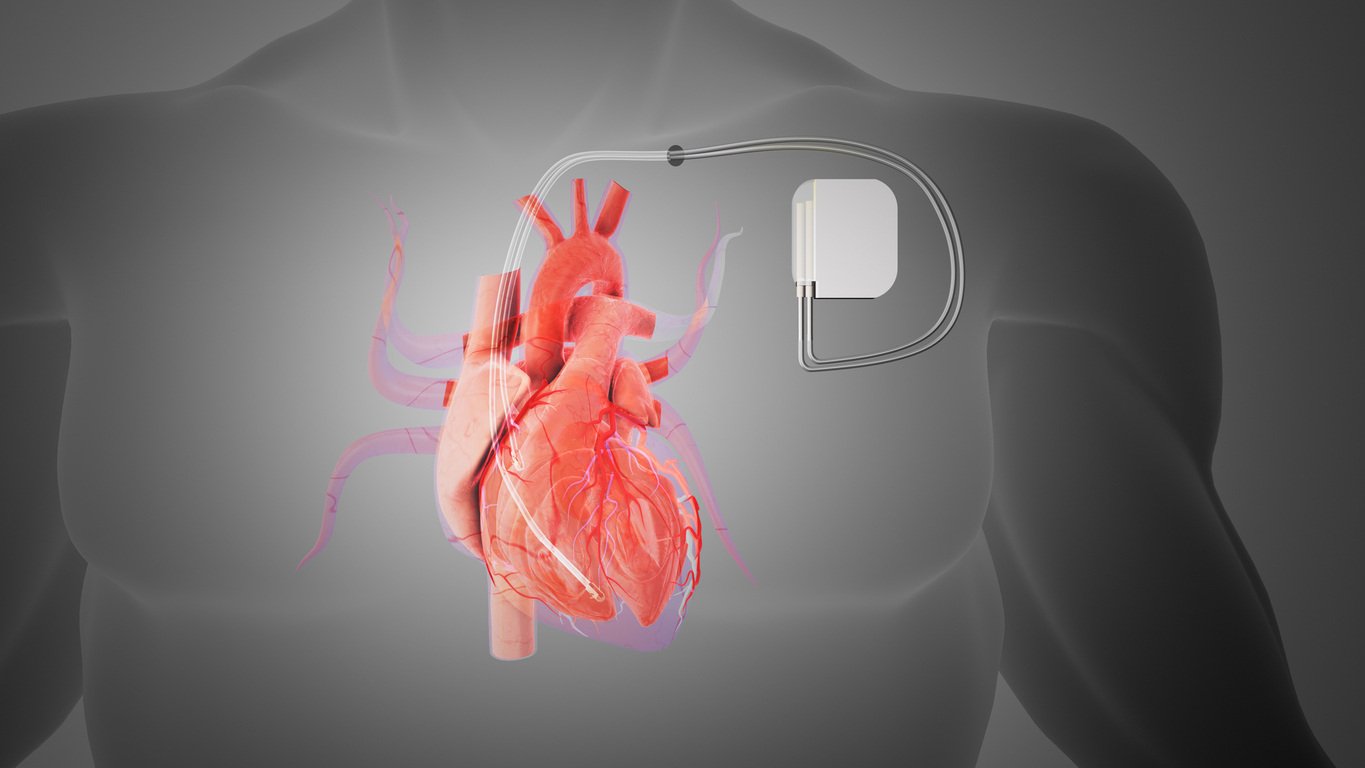 Coding for Insertion of Pacemakers vs. Defibrillators in ICD-10-PCS